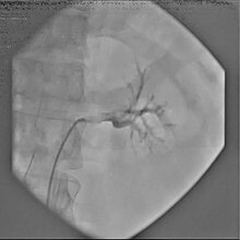 Файл: Почечная артерия angiography.ogv
