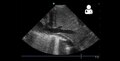 File:UOTW 29 - Ultrasound of the Week 3.webm