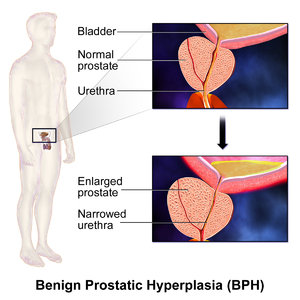 Benign Prostatic Hyperplasia (BPH).png