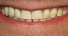 Крупным планом улыбающийся рот с зубами, показывающими незначительные белые полосы на одном зубе.