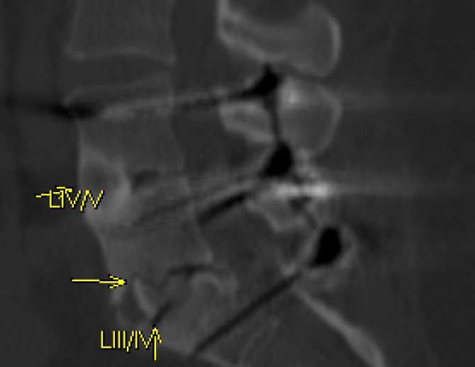 Datei:Spondylodese LIV SI MPR beschr.jpg