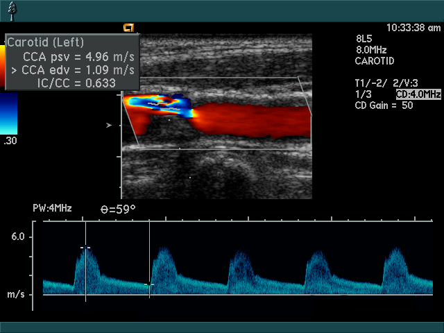 Datei:Stenose mit Doppler.png