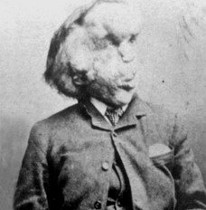 Joseph Carey Merrick "The Elephant Man"