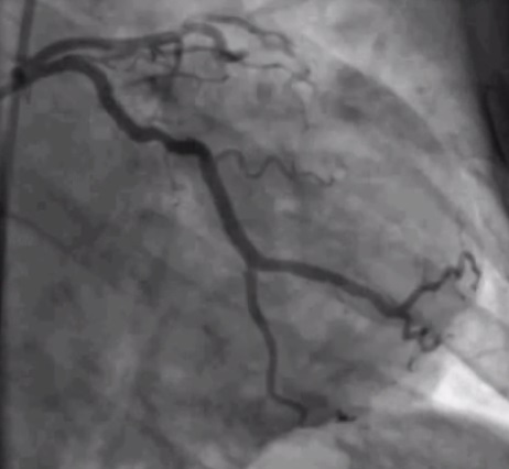 File:Coronary angiography of a STEMI patient with partial occlusion of left circumflex coronary artery, after being treated with percoutaneous coronary intervention.jpg