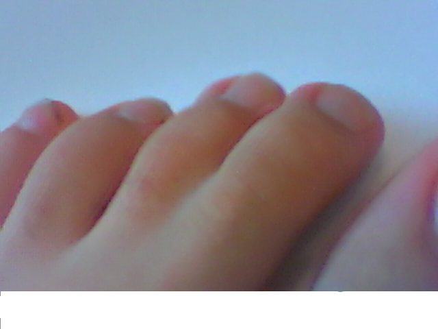 File:Syndactyly.jpg