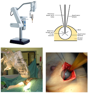 File:The technique of targeted intraoperative radiotherapy for breast cancer.png