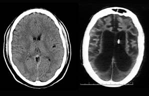 Left: Scan of normal 25-year-old's brain; Right: Schiavo's 2002 CT scan at age 38.