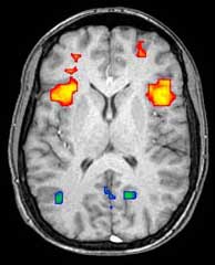 Axial MRI slice at the level of the basal ganglia, showing fMRI BOLD signal changes overlaid in red (increase) and blue (decrease) tones FMRIscan.jpg