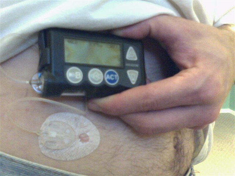 File:Minimed 515 and Silhouette Infusion set.jpg