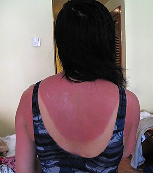 Sunburn, photographed 2 days after a 5-hour su...