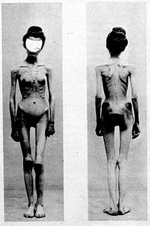 Two images of an anorexic woman published in 1900 in "Nouvelle Iconographie de la Salpetriere". The case was titled "Un cas d'anorexie hysterique" (A case of hysteric anorexia). Anorexia case-1900-Nouvelle icononographie de la Salpetriere.jpg