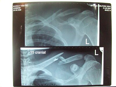 X-ray of a left clavicle