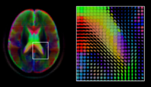 A mid-axial slice of the ICBM diffusion tensor image template. Each voxel's value is a tensor represented here by an ellipsoid. Color denotes principal orientation: red = left-right, blue=inferior-superior, green = posterior-anterior DiffusionMRI glyphs.png