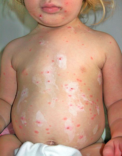 קובץ:Chickenpox22.jpg