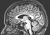 סריקת MRI של המוח בחתך חיצי