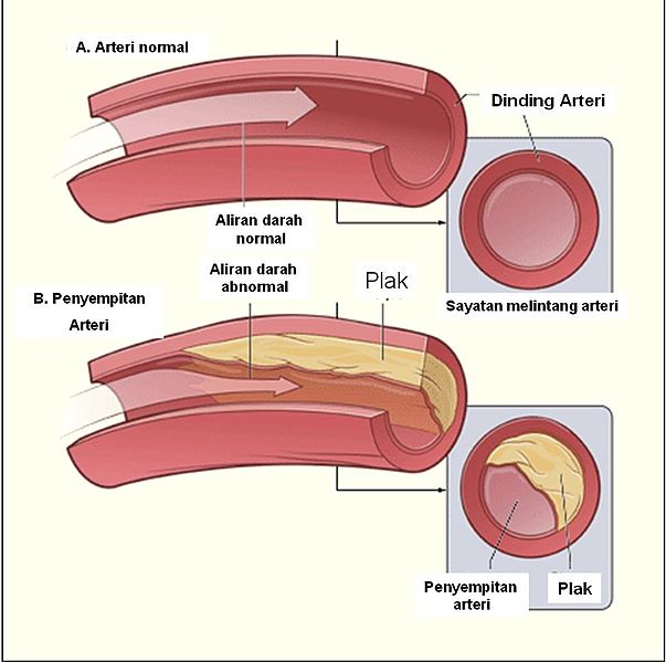 Berkas:Diagram aterosklerosis.jpg