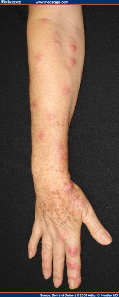 ფაილი:Sporotrichosis2 Medscape.gif