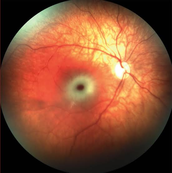 ಚಿತ್ರ:''CHERRY RED SPOT'' IN THE RETINA.jpeg