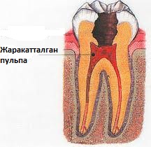 Файл:Пульпа.jpg