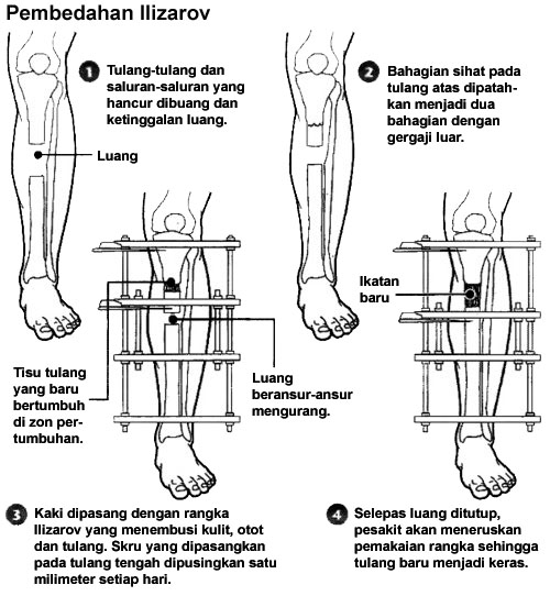 Fail:Ilizarov surgery.jpg