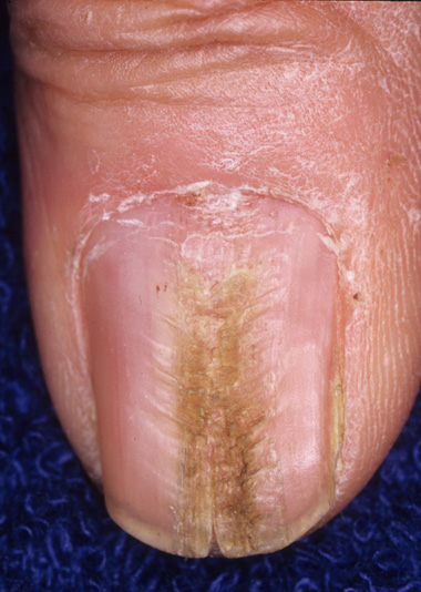 Файл:Mediannaildystrophy.jpg