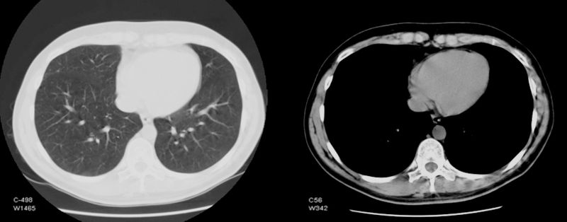 Файл:CT Chest.jpg