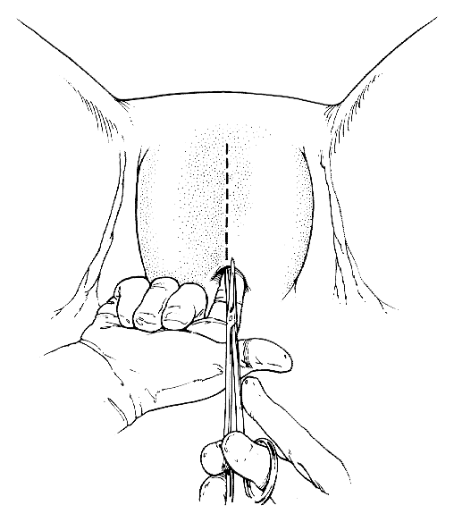 ගොනුව:Deinfibulation Procedure.gif