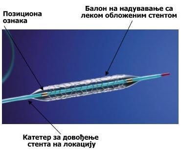 Датотека:Lekom obloženi stent 2.JPG