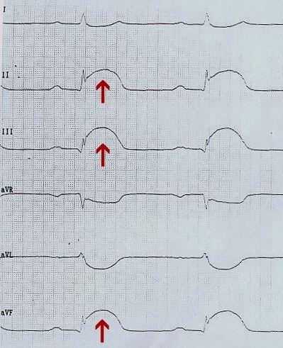 Датотека:Elevacija ST segmenta EKG.JPG