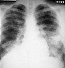 Akutni visinski edem pluća