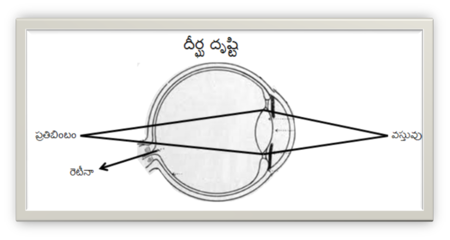 దీర్ఘ దృష్టి దోషము యేర్పడు విధానము