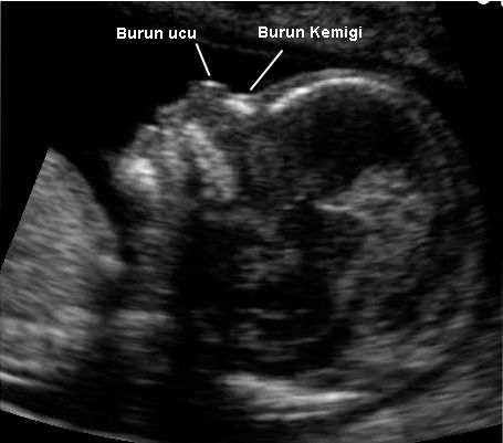 Dosya:14. haftadaki bir bebeğin burun kemiği incelemesi.jpg