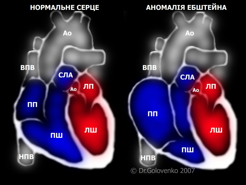 Файл:Ebstein Anomaly.jpg