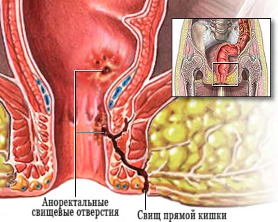 Файл:Зображення фістули прямої кишки.jpg