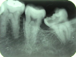 tóng-àn:Lower 3rd molar impaction.jpg