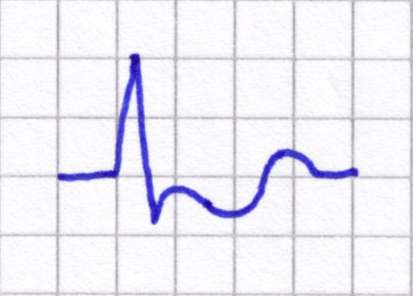 Datei:EKG ST 4.JPG