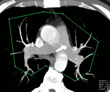 ファイル:OsiriX DrawROI2.jpg