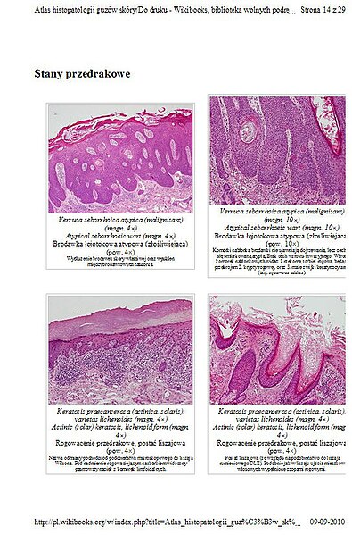 Plik:Atlas histopatologii guzów skóry-zrzut ekranu-Str14 IE.jpg