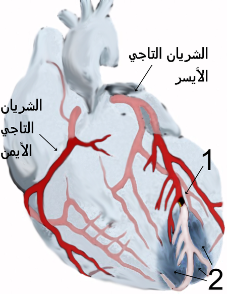 الشريانان التاجيان الأيمن والأيسر يغذيان عضلة القلب نفسها كي يعمل القلب. رسم يبيّن إحتشاء عضلة القلب، وعدم وصول الدم لجزء من عضلة القلب خلال الشريان التاجي الأيسر، بينما الشريان التاجي الأيمن مبين بصورة سليمة في الرسم أعلاه: المنطقة (1) فيها انسداد موضّح باللون الأسود داخل فرع من الشريان التاجي الأيسر الذي يُغذي الجزء السفلي من عضلة القلب. المنطقة (2) هي الجدار الأمامي لعضلة القلب، والذي لا يصله الدم بعد الإنسداد الحاصل في المنطقة (1)، ويُمكن رؤية الشريان من بعد الإنسداد وقد تغير لونه لنقص كمية الدم المارّ به، وكذلك لون المنطقة أسفل القلب المتأثرة بإنسداد الشريان متغير نتيجة نقص التروية الدموية وبالتالي نقص إمداد الأكسجين.