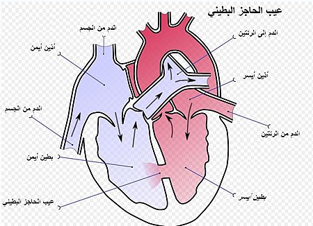 عيب الحاجز البطيني