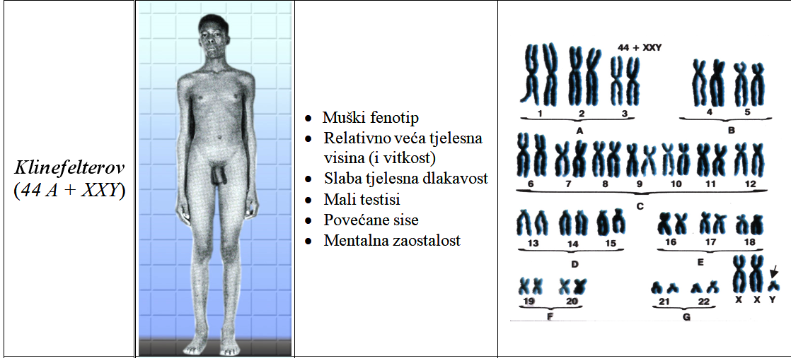 Xxy хромосома. Синдром Клайнфельтера кариограмма. Синдром Клайнфельтера евнухоидное. Синдром Клайнфельтера 47 xxy. Синдром Клайнфельтера клиника.