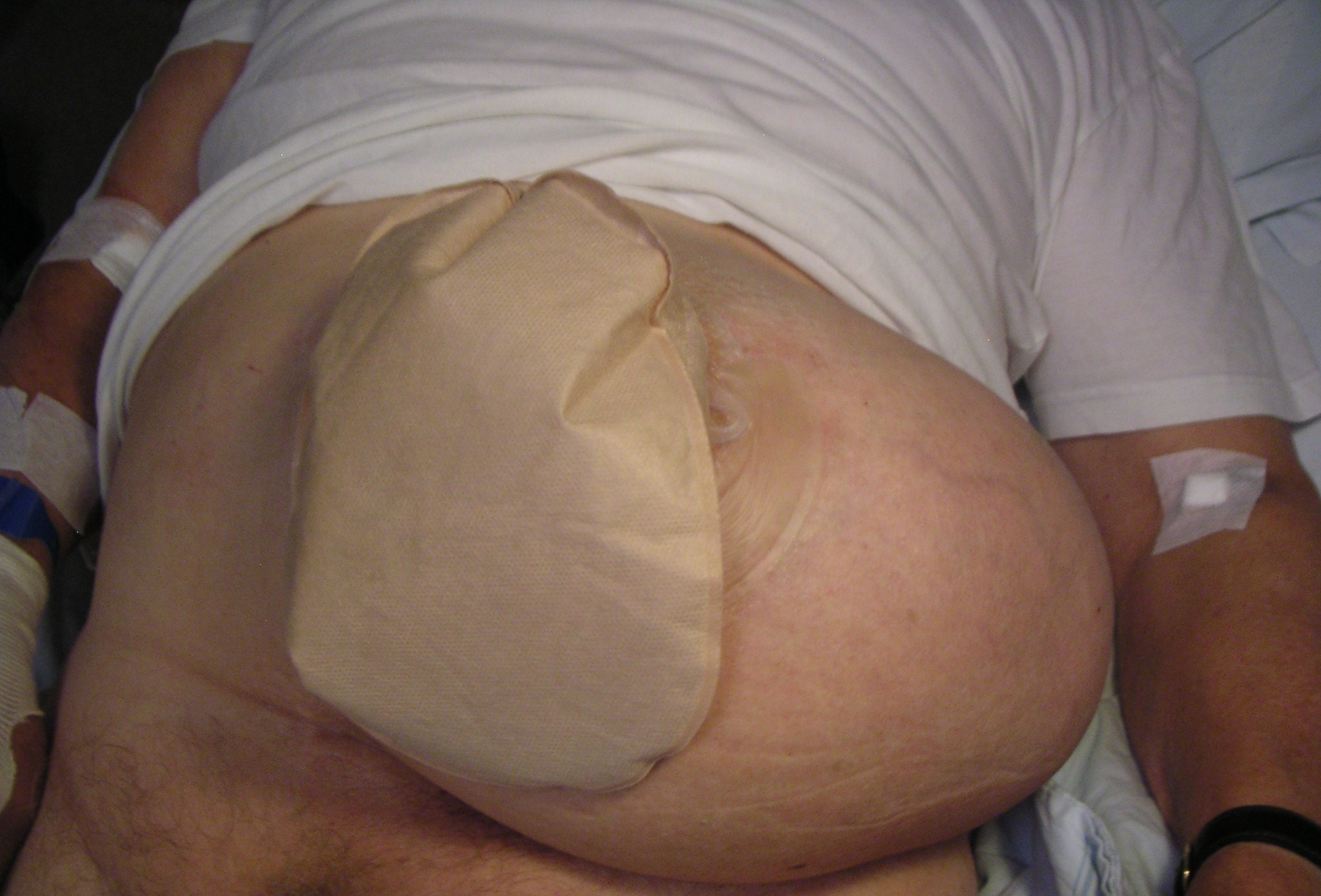 Patient with a colostomy complicated by a large parastomal hernia, which is when tissue protrudes adjacent to the stoma tract.