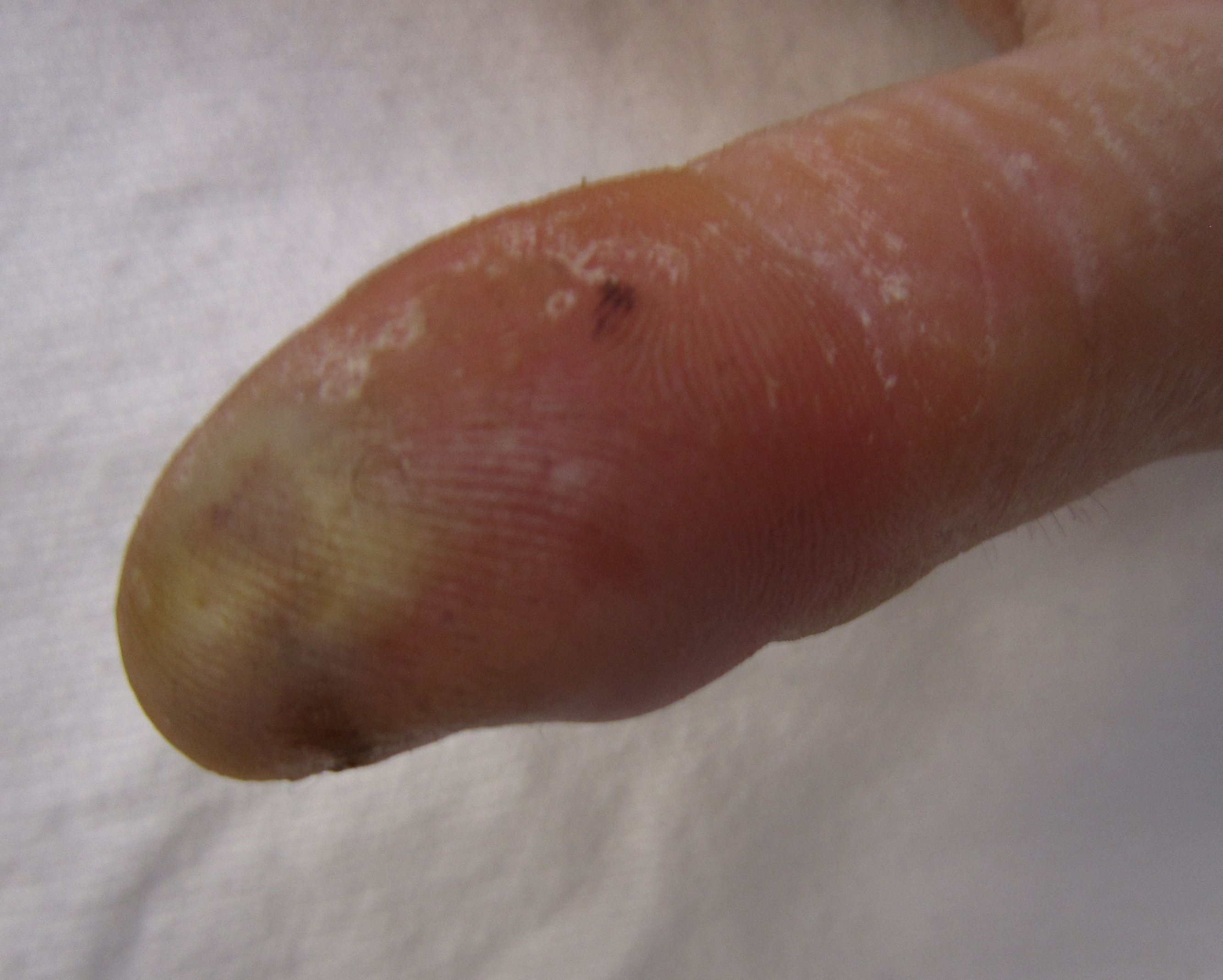Felon - finger pulp infection - YouTube
