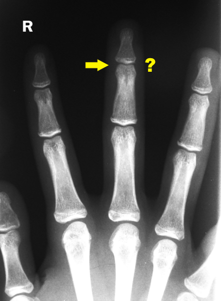 File:Mallet Xray anterior.png - Wiktionary, the free dictionary