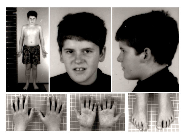 Case report: hands in patient with Prader-Willi syndrome.