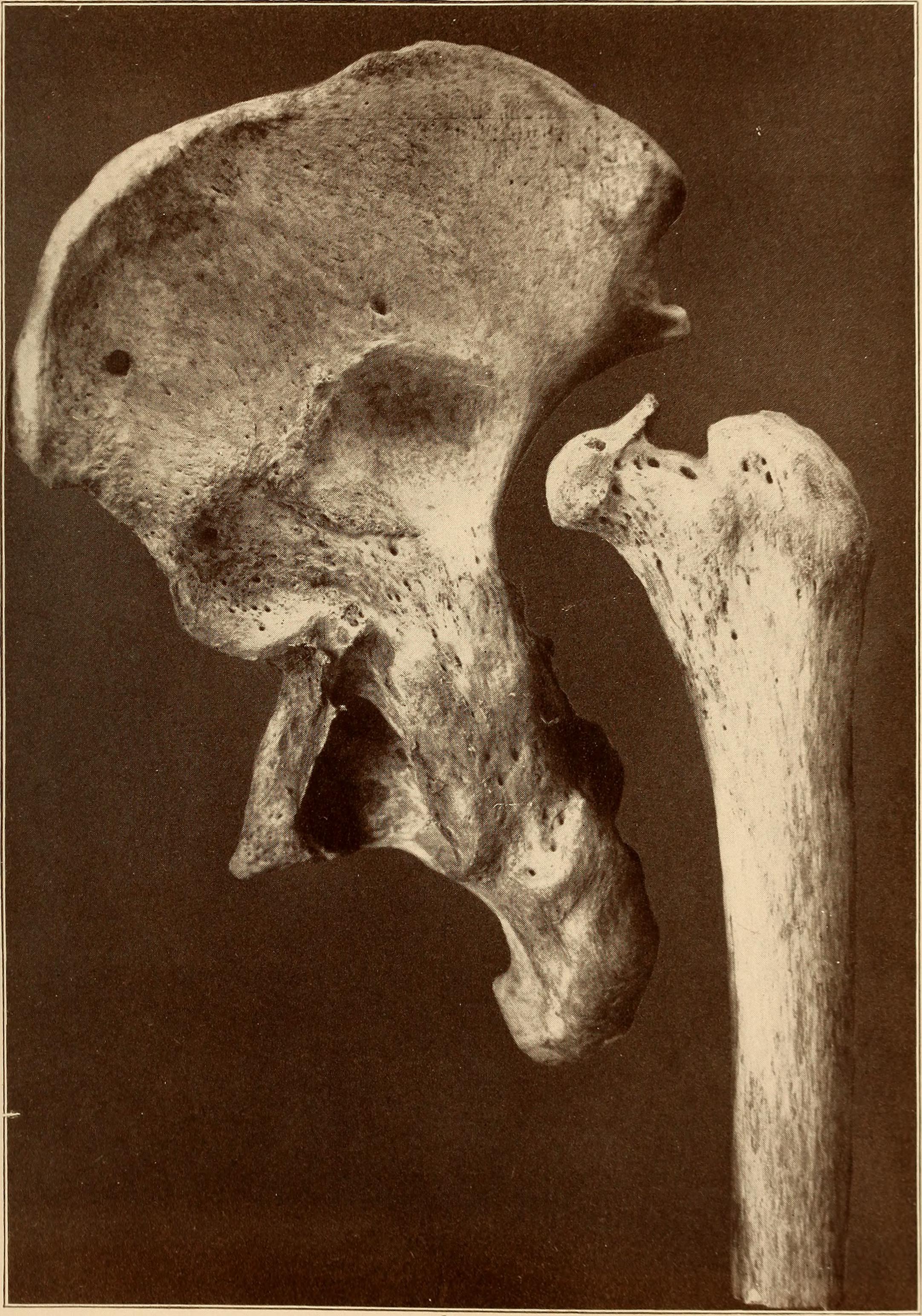 A practical treatise on fractures and dislocations . inside of the