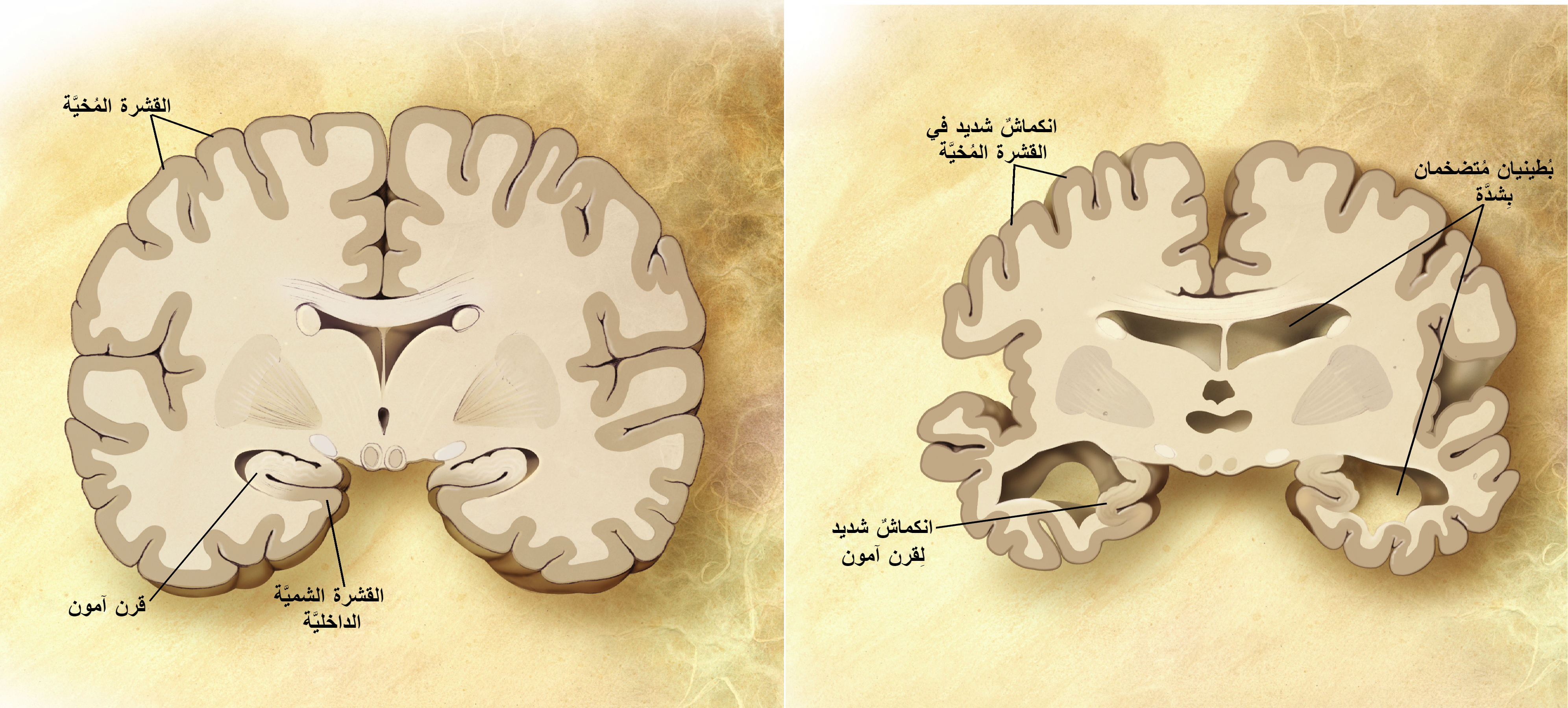 https://upload.wikimedia.org/wikipedia/commons/0/01/Alzheimer%27s_disease_brain_comparison-ar.jpg