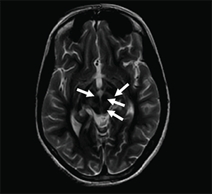 File:Face of the giant panda sign in Wilson's disease.png