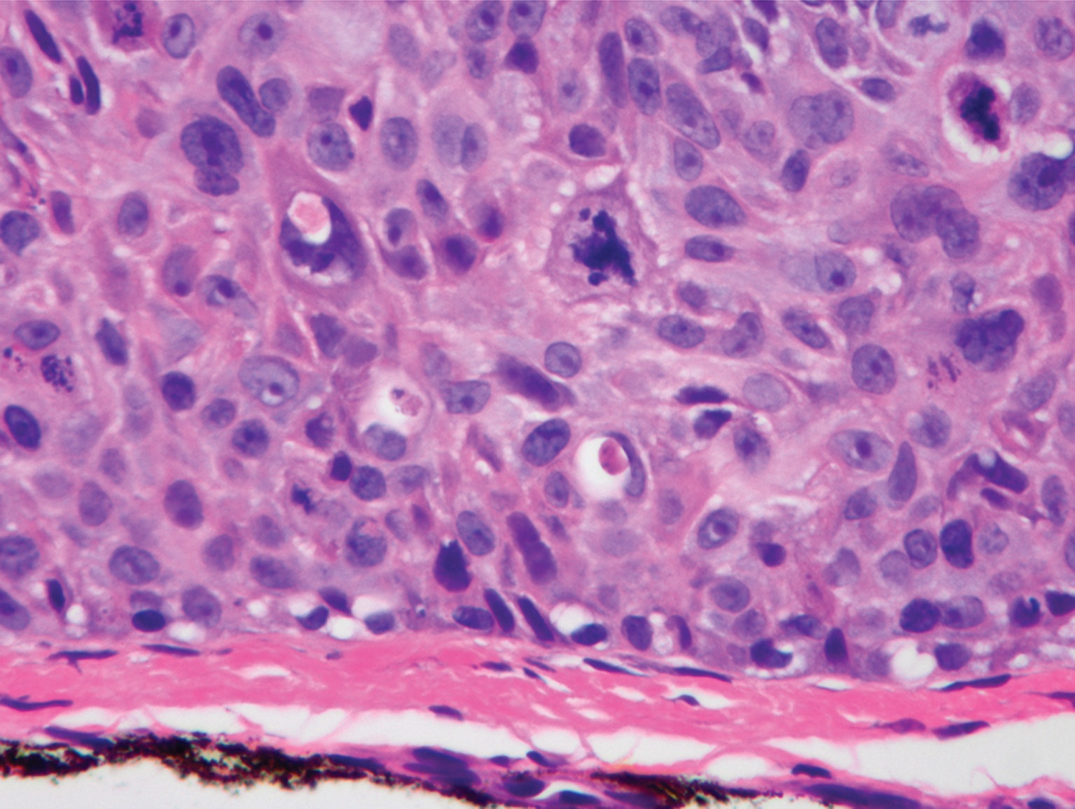 squamous cell carcinoma in situ histology