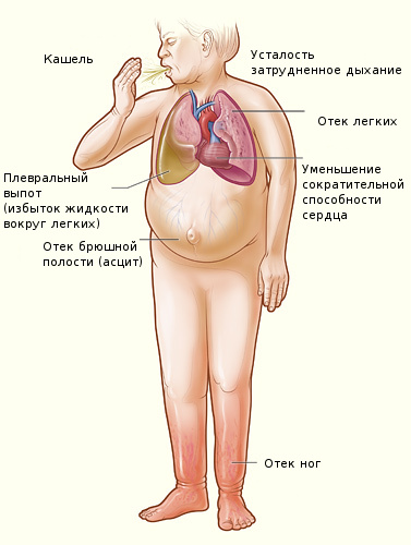 Сердце отекают. Отёки при сердечной недостатрчности. Симптомы сердечной недостаточности.